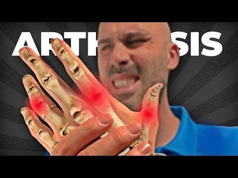 6 Easy Exercises to Relieve Hand and Finger Arthritis