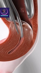 221K views · 1.5K reactions | Cervix dilation Procedure #doctor #documentaryphotography #DoctorWho # reel # shorts #DoctorWh# | SMART Doctor | Facebook