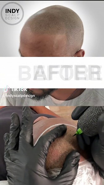 Scalp Micropigmentation is the only 💯 percent effective solution for hair loss. Hit us up for a free consultation. Indiana’s SMP Studio located just north of downtown Indianapolis in Broadripple. #smp #scalpmicropigmentation #hairtattoo #hairlinetattoo #scalpmicro