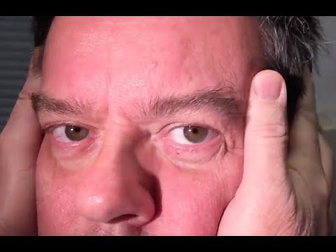 Clinical diagnosis of vestibular neuritis using the HINTS plus exam