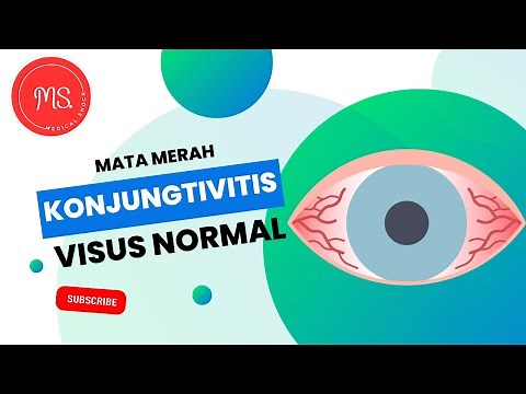 Mata Merah - Konjungtivitis - Definisi, Etiologi, Diagnosis, Tatalaksana, Prognosis dan Komplikasi