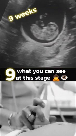 9 weeks ultrasound | Baby boy or girl ?, | what you can see at this stage#pregnancy #baby #shorts