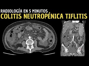 Radiology in 5 minutes: Neutropenic Colitis Typhlitis