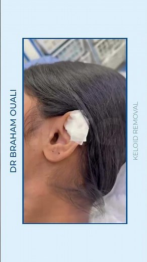 Minor Surgery Clinic – Keloid Removal (Surgical Excision)