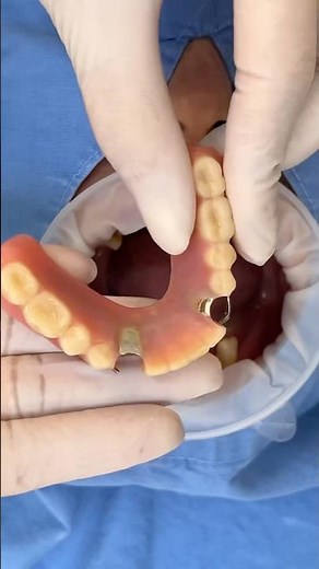 부분틀니 제거하고 전체임플란트 #dentist #dental #smiledesigndental #dentistry #implants