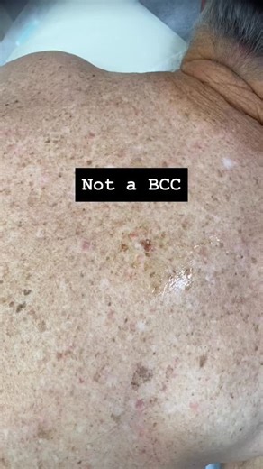 Dr John O’Bryen | Specialist GP | #skincheck #skincancer #skincancerdoctor #sunshinecoast #dermoscopy | Instagram