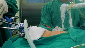 Transoral Endoscopic Thyroidectomy Vestibular Approach for Thyroid Lobectomy