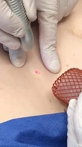 Treatment of eruptive vellus hair cysts