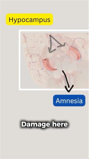 Medial temporal lobe damage