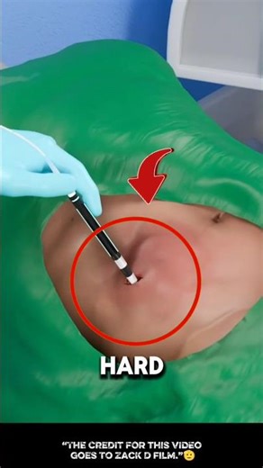 "Doctors Shocked After Removing a Live Eel from Man’s Stomach!"