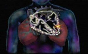 Sinus pause, Sinus arrestand sinus block