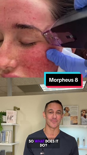 Have you guys tried morpheus 8? How was the pain? Were the results worth it? Check out this link to learn more about radiofrequency microneedling 👇🏼 https://www.avalon-laser.com/laser-treatment-clinic/microneedling-san-diego/ #skincare #microneedling #morpheus8 #painful #aesthetics #controversy #doctorsoftiktok #cosmeticdoctor #radiofrequency #scary #dermatology #medicalskincare #antiaging #collagen #hottake