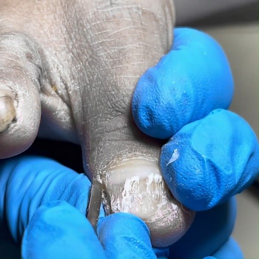 9K views · 100 reactions | The Front Of The Toenail Is Damaged, Cut Off The Fungus #nails #satisfying #pedicure | Liu Yidao | Facebook
