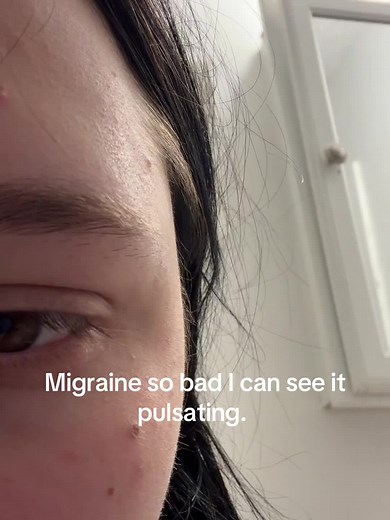 Understanding Pulsating Migraines and TMJ Pain