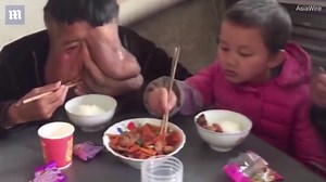 China's 'elephant man' with facial tumour rejects freak show offer