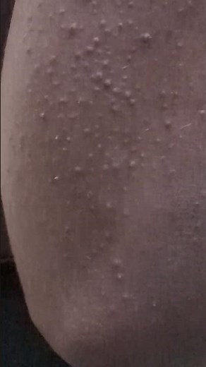 #phrynoderma,#toad skin, #treatment.