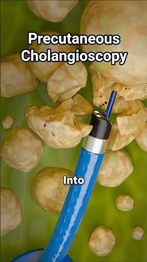 How Do Doctors Remove Gallbladder Stones Without Surgery?