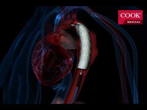 Thoracic Endovascular Aortic Repair (TEVAR)
