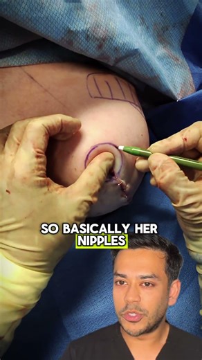 🔥Wait…Where Did the Nipples Go? (Breast Surgery Explained) - Dr. Arsalan | West End Plastic Surgery
