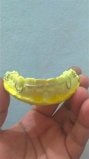 Orthodontic treatment to lower high teeth!