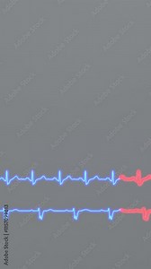 ECG of cardiac arrhythmias. Right bundle branch block and left bundle branch block.