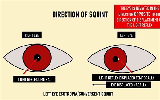【中英双字】【角膜映光法(Hirschbeng法)的斜视检查】Hirschberg Test Explained