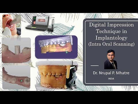 Digital Impression Technique in Implantology (Intra Oral Scanning)