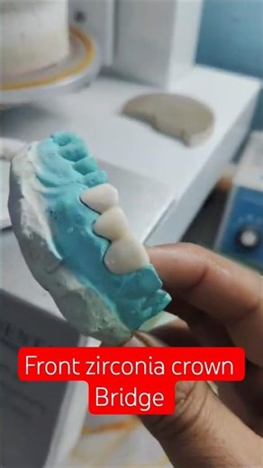 Front Teeth Zirconia and Crown vs zirconia crown Bridge l #zirconia bridge #trending #shorts #viral