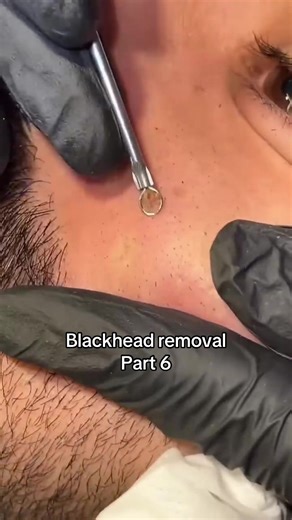 Effective Blackhead Extraction Techniques