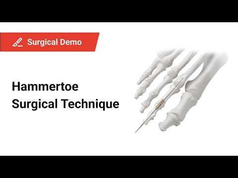 PIP Fusion Technique: Implant Placement & Surgical Workflow