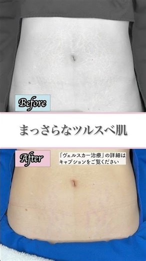 気になる妊娠線治療「ヴェルスカー」のビフォーアフター