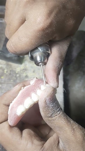 Carving Of Soft Lining Complete Denture 😁😁😁#softdenture #dentures #completedenture