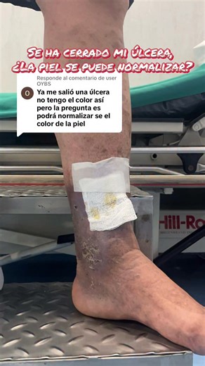 La piel de la dermatitis ocre o una úlcera varicosa luego del tratamiento ya cerrada la herida puede aclarar hasta un 85% pero el objetivo es evitar nueva úlcera y bajar el riesgo de trombosis venosa. Dr José Luis Tapia Basurto Cirujano cardiovascular Lima-Perú Citas al 993663614 #varices #lima #dermatitisocre #cirujanocardiovascular #laser #ulcerasvenosas | Dr. José Luis Tapia