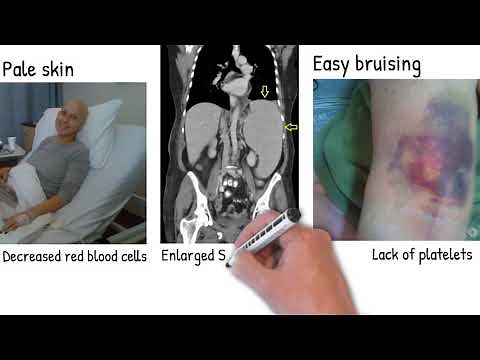 Leukemia - Easy explained . types of Leukemia and prognosis