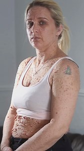 Rachael has a genetic disorder which leaves her with large bubble-like lesions all over her body | Born Different
