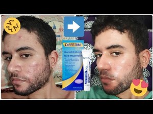 My 4 Months Acne Journey Using Differin Gel! before and after