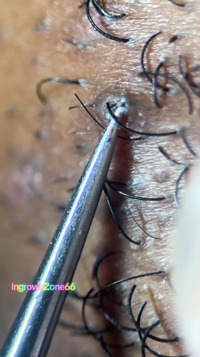 Ingrown Hair Removal: An ASMR Extraction Experience