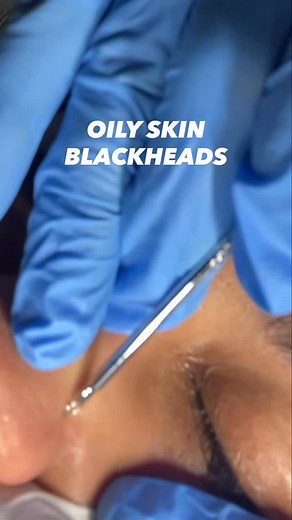 4.2K views | Blackhead Removal for Oily & Acne-Prone Skin -...