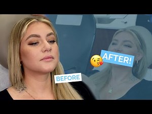 Restylane Defyne Lip Fillers | What Happens During and After?