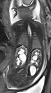 Megaureters due to bilateral duplex kidneys (prenatal and neonatal imaging) | Radiology Case | Radiopaedia.org