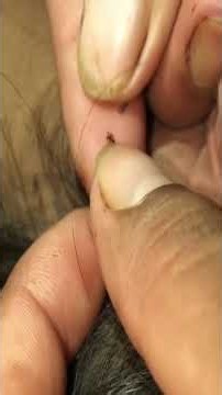 #satisfying #animals #pimple #hair #blackheads #licetreatment #lice #liceremoval