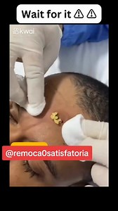 Relaxing Time 😍🥰😘 | Pimple Popping