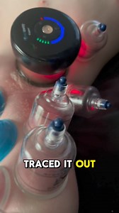 1.7K views · 18 reactions | Cupping pulls apart the muscle to fascia compression and brings major alleviation! Using different types of cupping helps to enhance the benefits for the client.#cupping #fascia #myofascialrelease #bodywork #painrelief | Greater Therapeutics | Facebook