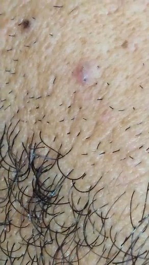Ingrown Hair Removal ; Ingrown Hairs Extraction;ingrown hair treatment
