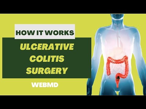 How Ulcerative Colitis Surgery Works | 3D Medical Animation | Pixeldust Studios