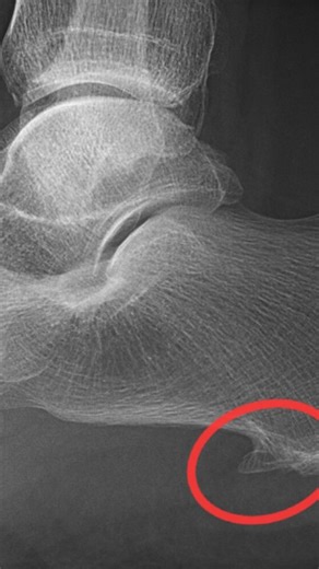 Vaibhav Shah-Physiotherapist on Instagram: ""ઘણા ટ્રીટમેન્ટ બાદ પણ જો એડીનો દુખાવો સાજો ન થયો હોય તો હવે નિરાશ ન થાઓ! Extracorporeal Shock Wave Therapy સાથે શક્ય છે અસરકારક અને લાંબી રાહત! દર્દ વગરનું જીવન — હવે શક્ય છે Shree Physio and Pain Clinic માં 💪 — Dr. વૈભવ શાહ" #ShockWaveTherapy #PhysiotherapyWorks #CalcificTendinitis #ShoulderPainRelief #PainFreeLife #AdvancedPhysiotherapy #ESWTtherapy #HealingWithWaves #PhysioCare #InjuryRecovery #MusclePainRelief #NonSurgicalTreatment #ShreePhysioAn