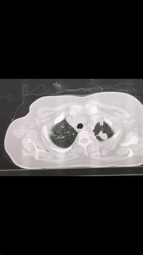 25K views · 195 reactions | History.. Cancer brest Chest pain Diagnosis? | Radiology - 1895 | Facebook