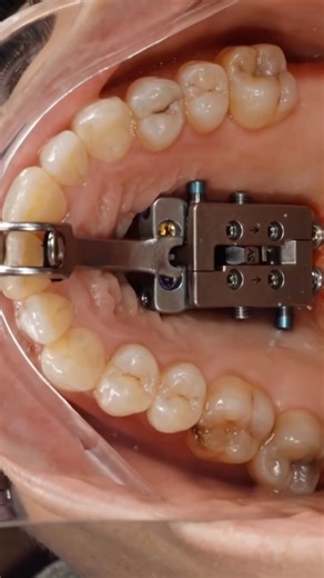 Dr. Svitlana Koval on Instagram: "FME applies forces directly to the bone. In some occasions it might take more time to separate the midpalatal suture compared to custom MARPE that has tooth anchorage. The reason is custom MARPE forces are distributed in multiple directions creating vectors over a larger surface area. #drkovalorthodontics #airwayorthodontics #fme #marpe #marpeface™️"