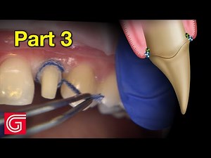 How To Prepare Peg Lateral Tooth #10 Before Digital Scanning - Part 2 • Video • MEDtube.net