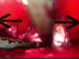 vNOTES Isolation of Anterior Vesicouterine Peritoneum • Video • MEDtube.net
